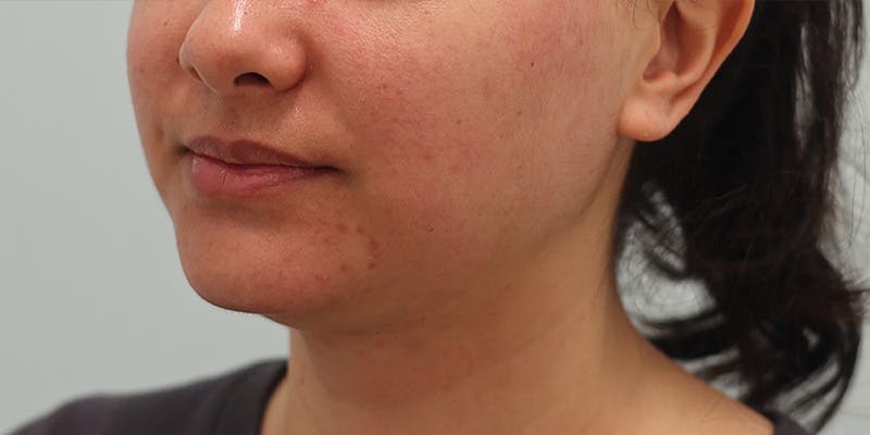 Neck Liposuction Before & After Gallery - Patient 820885 - Image 5