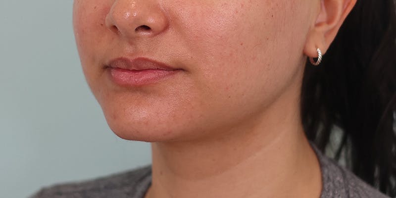 Neck Liposuction Before & After Gallery - Patient 820885 - Image 6