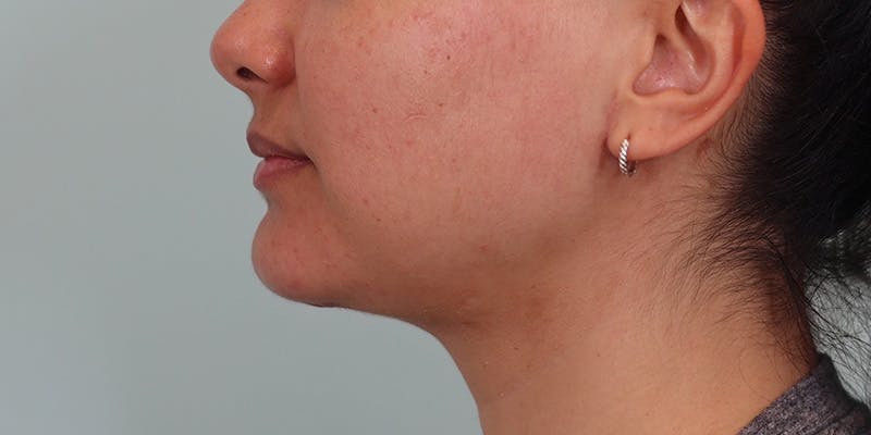 Neck Liposuction Before & After Gallery - Patient 820885 - Image 8