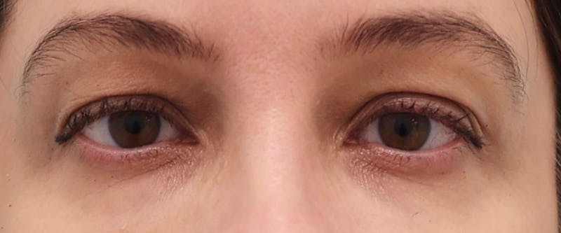 Upper Blepharoplasty Before & After Gallery - Patient 396414 - Image 1