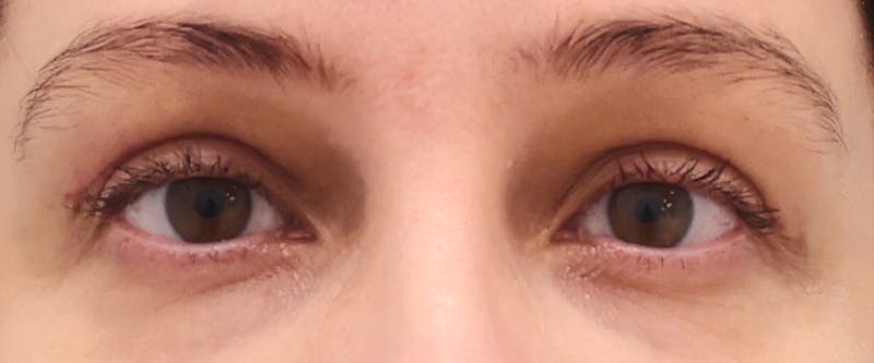 Upper Blepharoplasty Before & After Gallery - Patient 396414 - Image 2