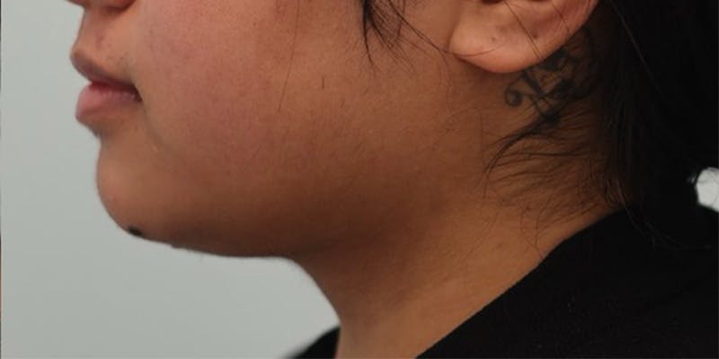 Neck Liposuction Before & After Gallery - Patient 366636 - Image 4
