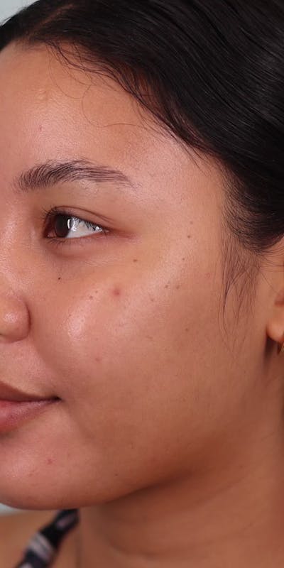 Skin Treatments Before & After Gallery - Patient 169158 - Image 2