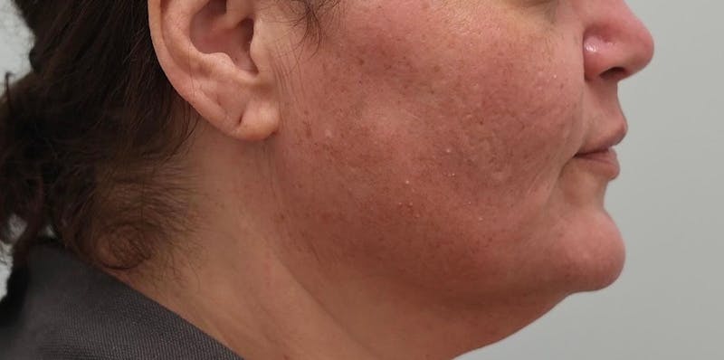 Skin Treatments Before & After Gallery - Patient 409695 - Image 10