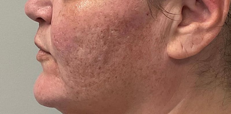 Skin Treatments Before & After Gallery - Patient 409695 - Image 5