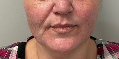 Skin Treatments Before & After Gallery - Patient 409695 - Image 1