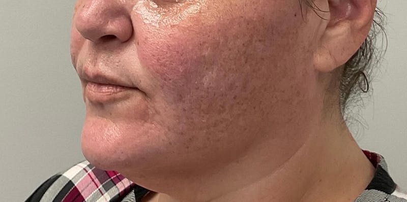 Skin Treatments Before & After Gallery - Patient 409695 - Image 3