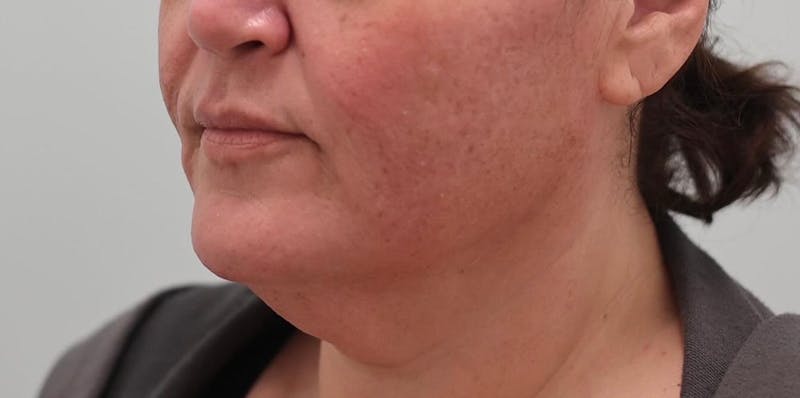 Skin Treatments Before & After Gallery - Patient 409695 - Image 4