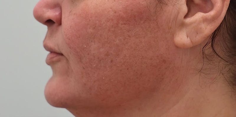 Skin Treatments Before & After Gallery - Patient 409695 - Image 6
