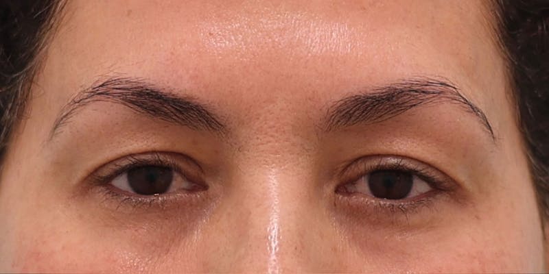 Upper Blepharoplasty Before & After Gallery - Patient 249740 - Image 1