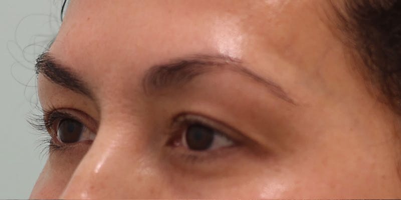 Upper Blepharoplasty Before & After Gallery - Patient 249740 - Image 3