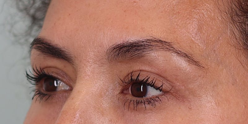 Upper Blepharoplasty Before & After Gallery - Patient 249740 - Image 4