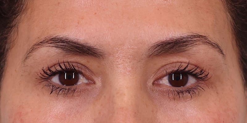 Upper Blepharoplasty Before & After Gallery - Patient 249740 - Image 2