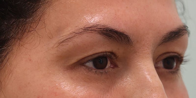 Upper Blepharoplasty Before & After Gallery - Patient 249740 - Image 5