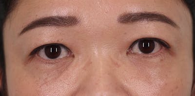 Lower Blepharoplasty Before & After Gallery - Patient 249782 - Image 2