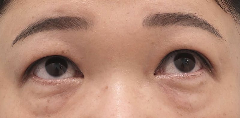 Lower Blepharoplasty Before & After Gallery - Patient 249782 - Image 3