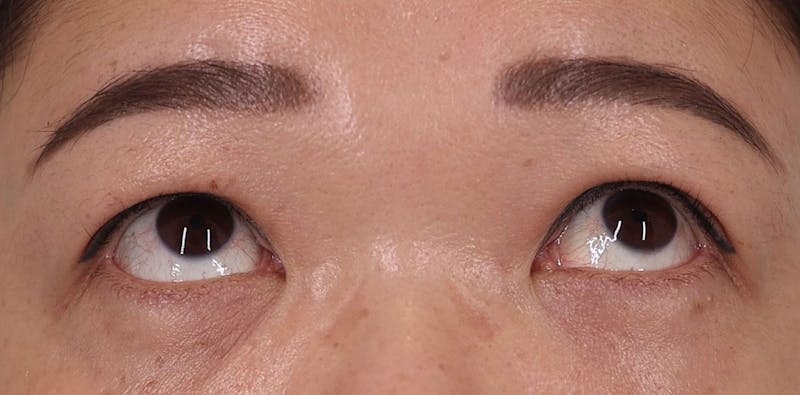 Lower Blepharoplasty Before & After Gallery - Patient 249782 - Image 4