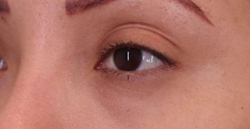 Under Eye Growth Factors Before & After Gallery - Patient 284409 - Image 5
