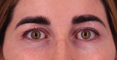 Upper Blepharoplasty Before & After Gallery - Patient 454011 - Image 2