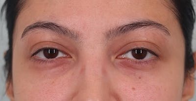 Under Eye Growth Factors Before & After Gallery - Patient 143940 - Image 2