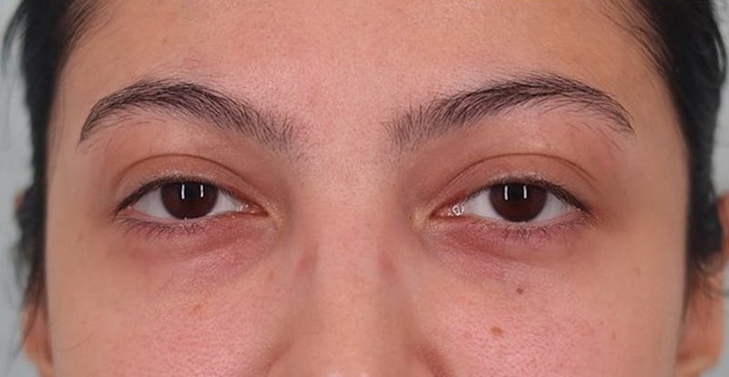 Under Eye Growth Factors Before & After Gallery - Patient 143940 - Image 2
