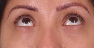 Under Eye Growth Factors Before & After Gallery - Patient 284409 - Image 2