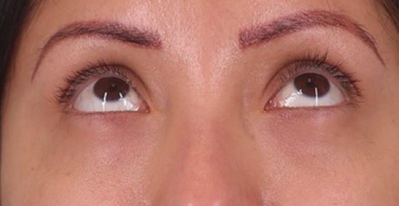 Under Eye Growth Factors Before & After Gallery - Patient 284409 - Image 2