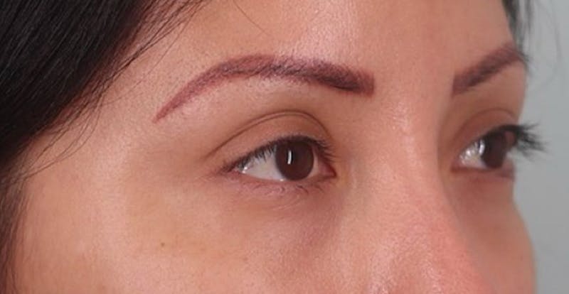 Under Eye Growth Factors Before & After Gallery - Patient 284409 - Image 4