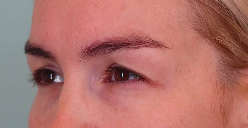 Upper Blepharoplasty Before & After Gallery - Patient 148143 - Image 5