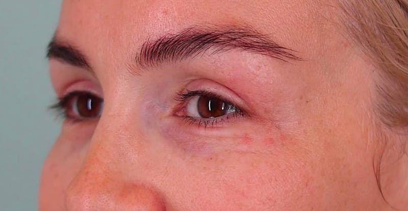 Upper Blepharoplasty Before & After Gallery - Patient 148143 - Image 6