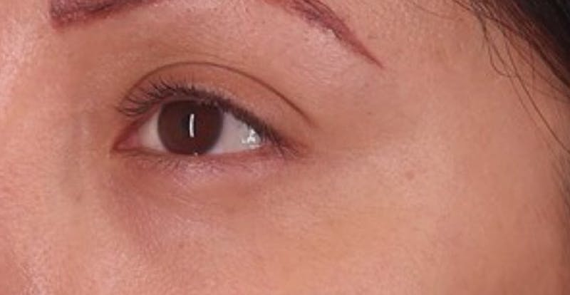 Under Eye Growth Factors Before & After Gallery - Patient 284409 - Image 6