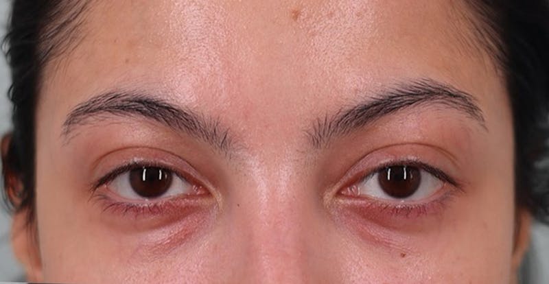 Under Eye Growth Factors Before & After Gallery - Patient 143940 - Image 1