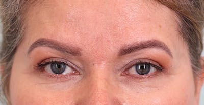 Upper Blepharoplasty Before & After Gallery - Patient 340265 - Image 2