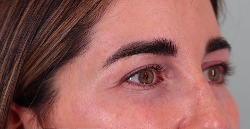 Upper Blepharoplasty Before & After Gallery - Patient 454011 - Image 4