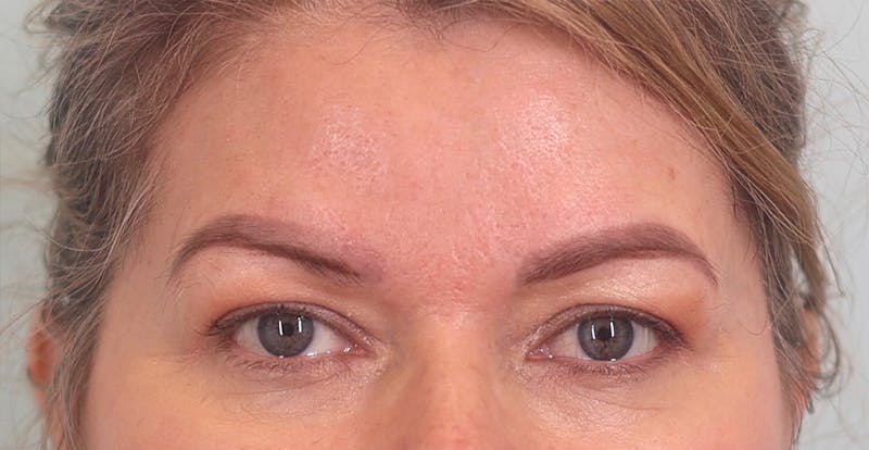 Upper Blepharoplasty Before & After Gallery - Patient 340265 - Image 1