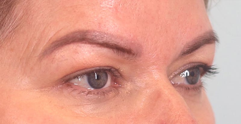 Upper Blepharoplasty Before & After Gallery - Patient 340265 - Image 3