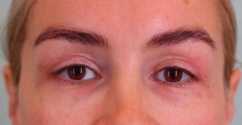 Upper Blepharoplasty Before & After Gallery - Patient 148143 - Image 2
