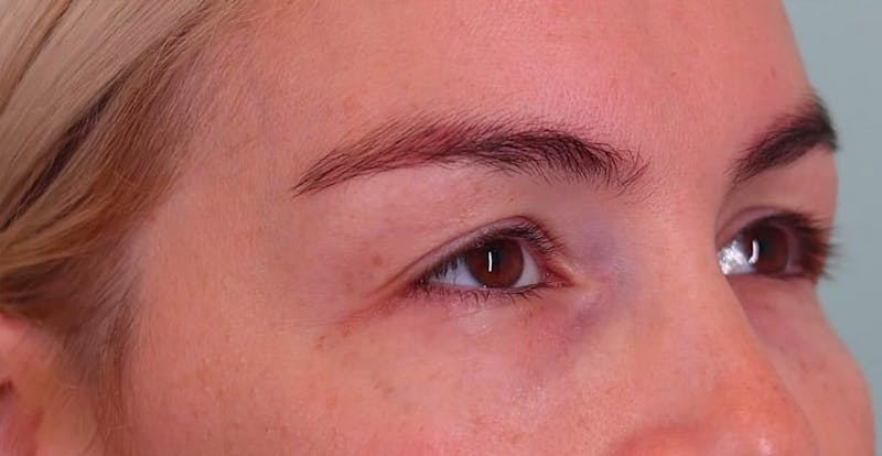 Upper Blepharoplasty Before & After Gallery - Patient 148143 - Image 3