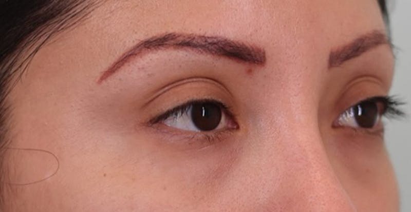 Under Eye Growth Factors Before & After Gallery - Patient 284409 - Image 3