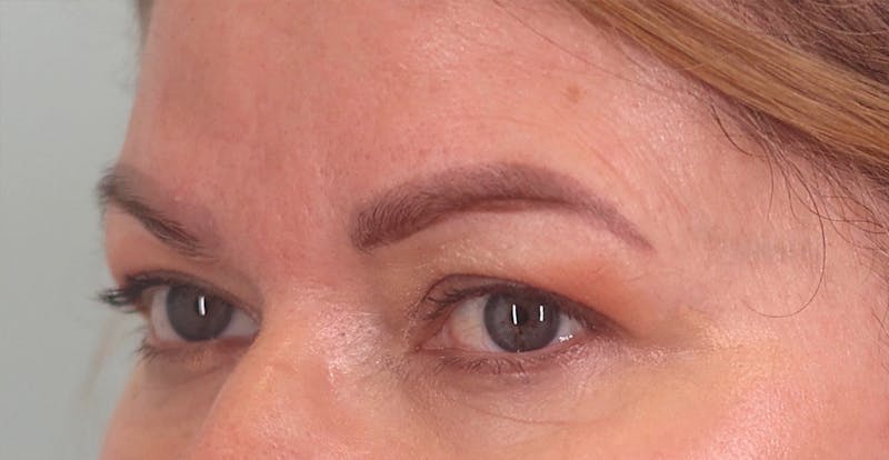 Upper Blepharoplasty Before & After Gallery - Patient 340265 - Image 5