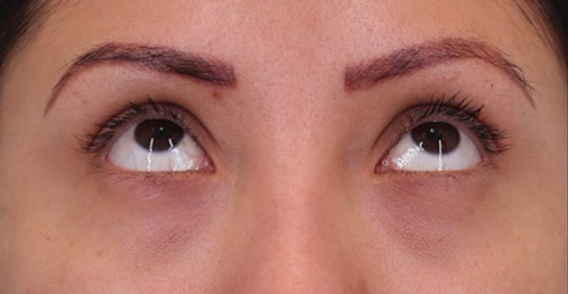 Under Eye Growth Factors Before & After Gallery - Patient 284409 - Image 1