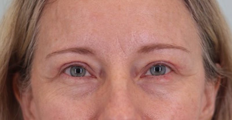 Upper Blepharoplasty Before & After Gallery - Patient 377538 - Image 2