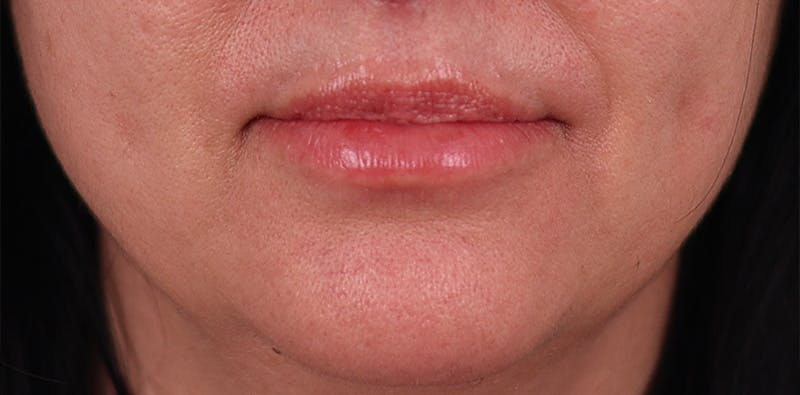 Lip Lift Before & After Gallery - Patient 146928 - Image 2