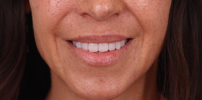 Lip Lift Before & After Gallery - Patient 102345 - Image 1