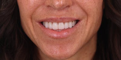 Lip Lift Before & After Gallery - Patient 102345 - Image 2