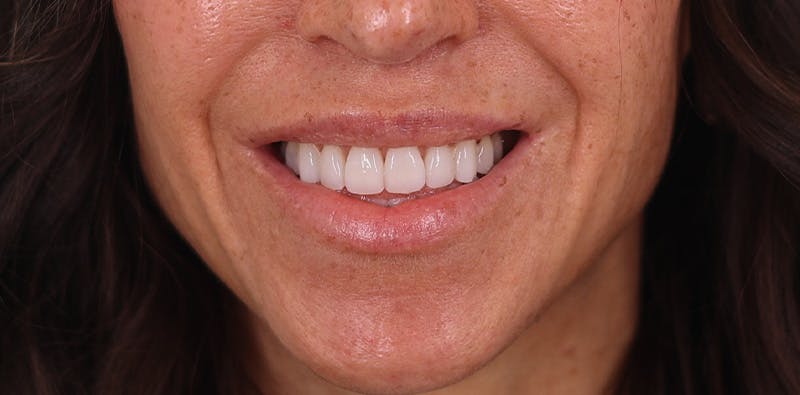 Lip Lift Before & After Gallery - Patient 102345 - Image 2