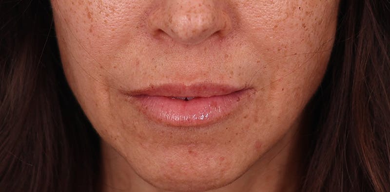 Lip Lift Before & After Gallery - Patient 102345 - Image 3