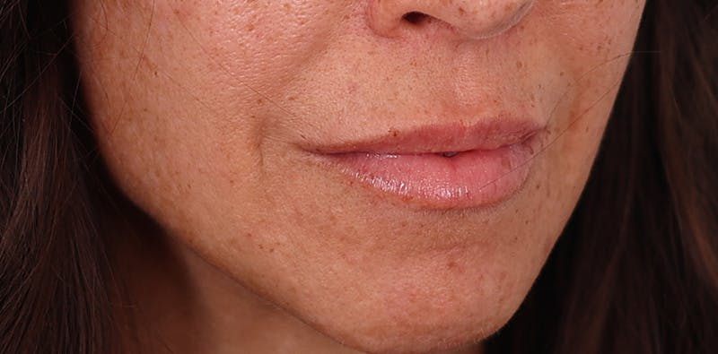 Lip Lift Before & After Gallery - Patient 102345 - Image 5