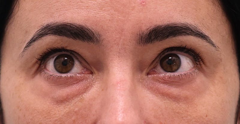 Upper Blepharoplasty Before & After Gallery - Patient 352796 - Image 1