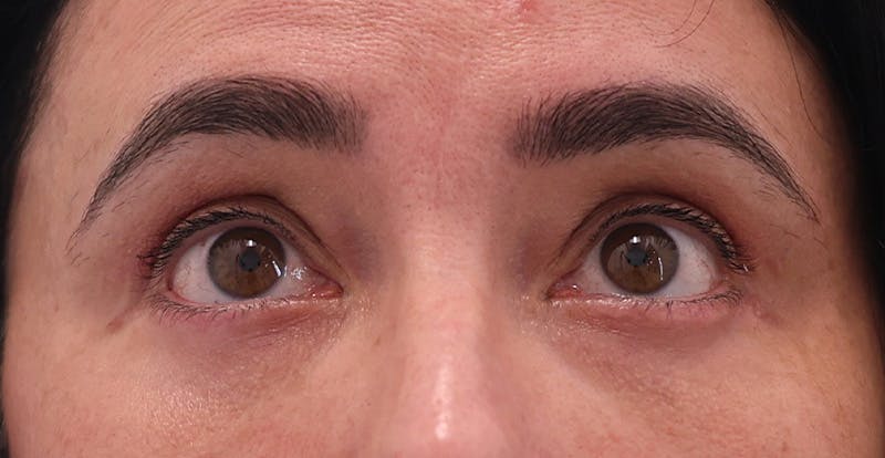 Upper Blepharoplasty Before & After Gallery - Patient 352796 - Image 2